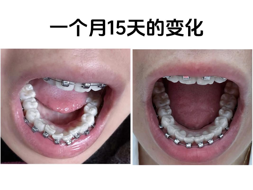 成都38岁做牙齿矫正晚不晚 过来人告诉你真实经历