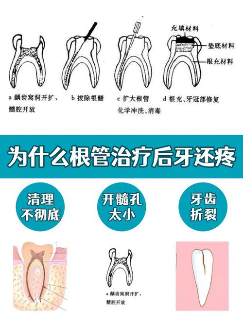 成都根管治疗是种牙吗 别再混淆两者天差地别