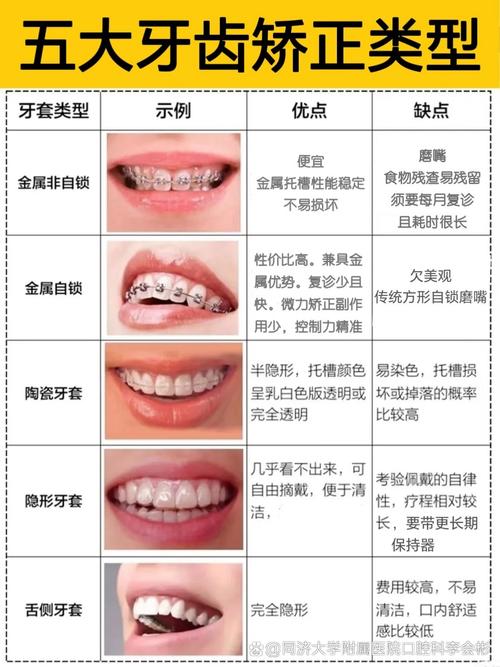 成都成人畸牙矫正全攻略 别再错过最佳时机