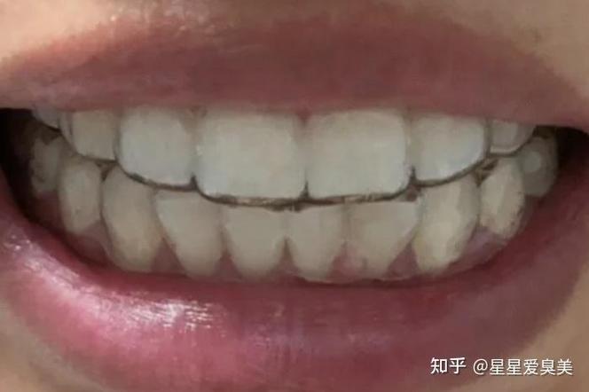 成都24岁矫正牙齿要花多少钱 这笔钱到底值不值