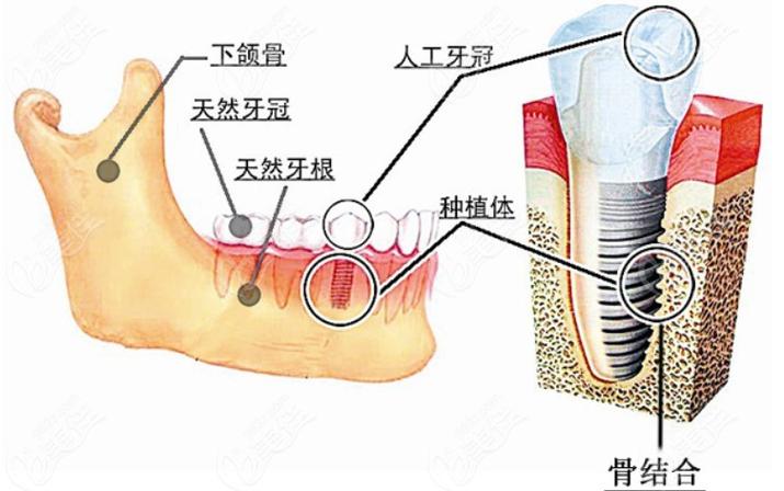 成都深圳瑞士ITI种植牙 牙槽骨条件要求详解