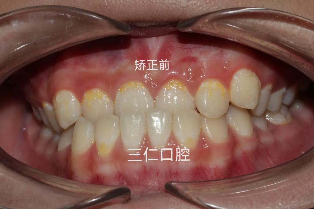 成都种一颗牙矫正价格是多少 看完这篇心里有数