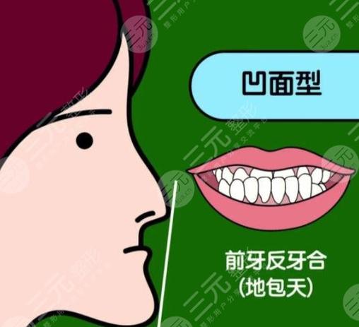 成都深圳儿童地包天矫正多少钱？2026最新价格表来了
