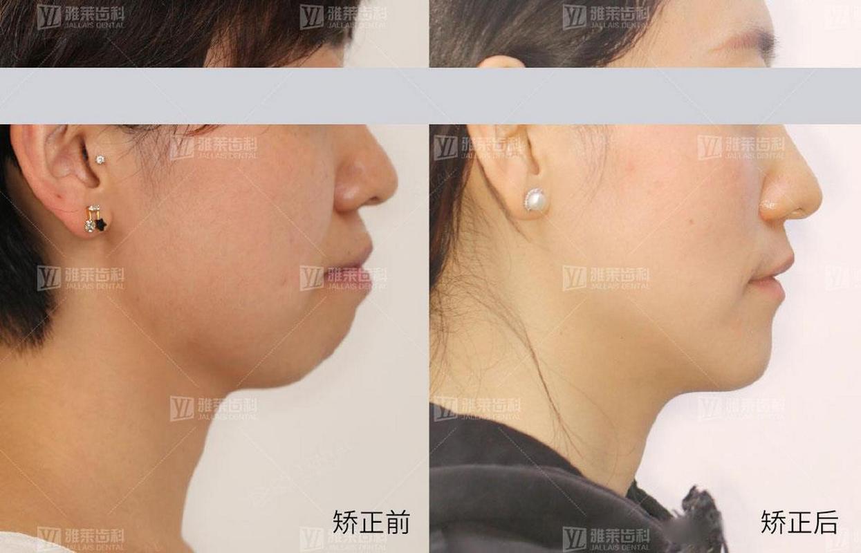 成都矫正牙齿对脸型的改变到底有多大？真实对比告诉你