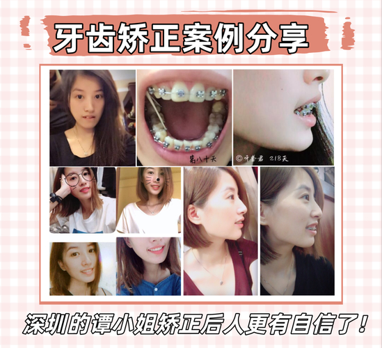 成都深圳福田成人地包天正畸医院怎么选？看完这篇不踩坑