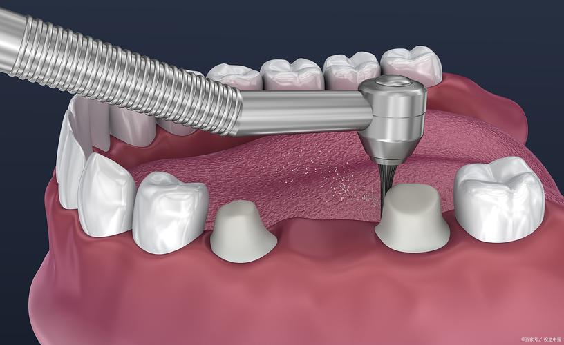 成都东莞微创种植牙多少钱？疼不疼？一篇讲透