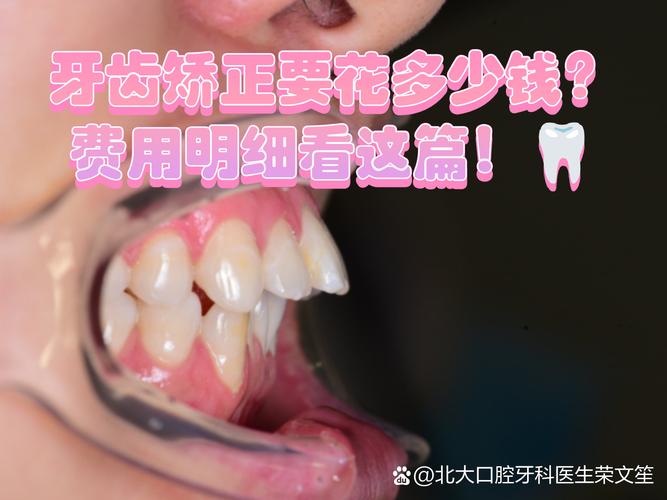 成都广州牙齿矫正到底要花多少钱？看完这篇不踩坑