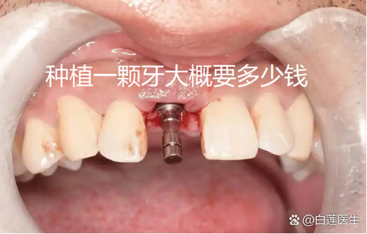成都纯钛种牙多少钱一颗？费用明细和影响因素都在这里