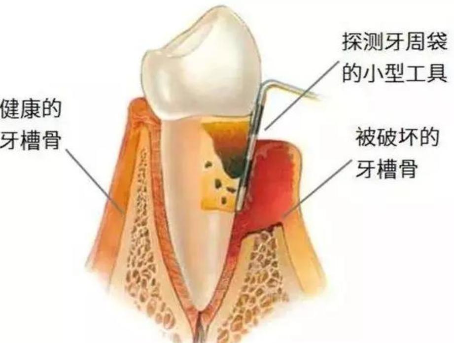 成都深圳牙槽骨太薄种牙有救吗？医生说实话