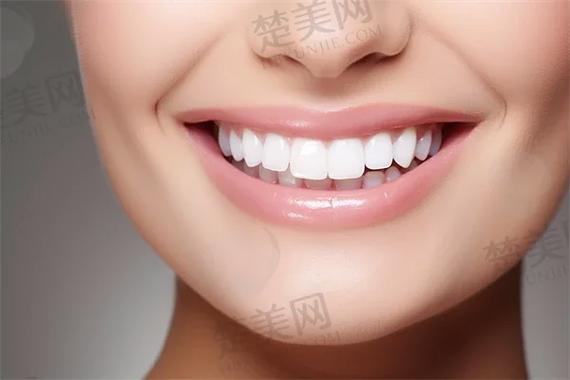成都杭州自锁牙齿矫正多少钱？真实费用全揭秘