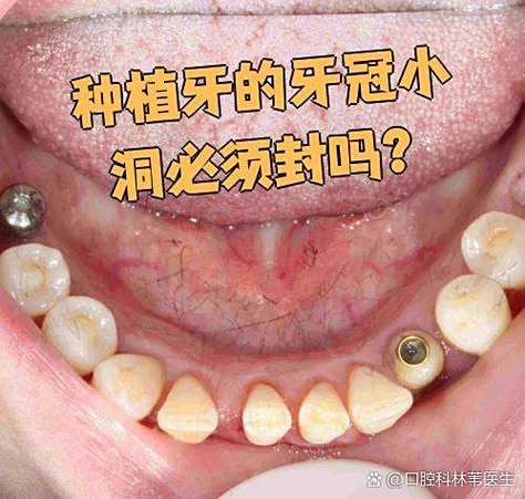 成都深圳龙华全口种牙当天戴牙冠靠谱吗