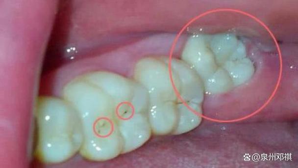 成都拔牙后能马上种牙吗？看完这篇就懂了
