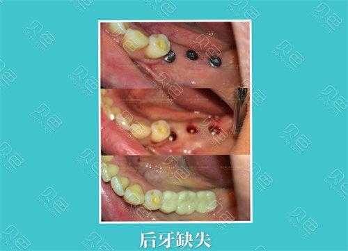 成都龙岗中心城种植牙医院怎么选 本地人的真实推荐