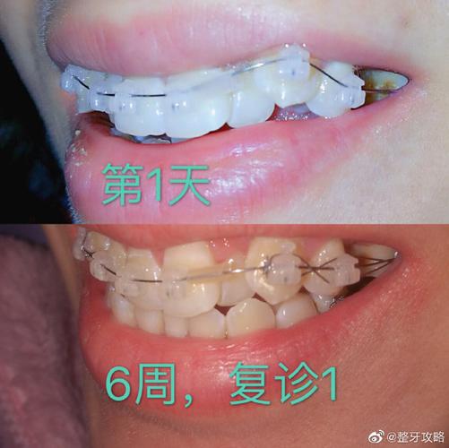 成都深圳牙缝过大矫正多少钱 价格表一览