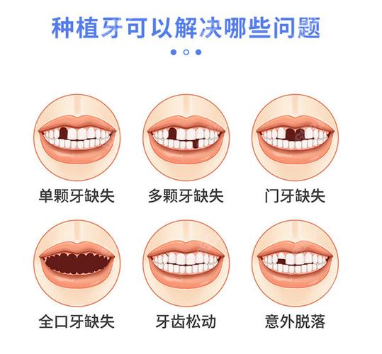 成都宝安新安种植牙哪家医院好？靠谱选择看这几点