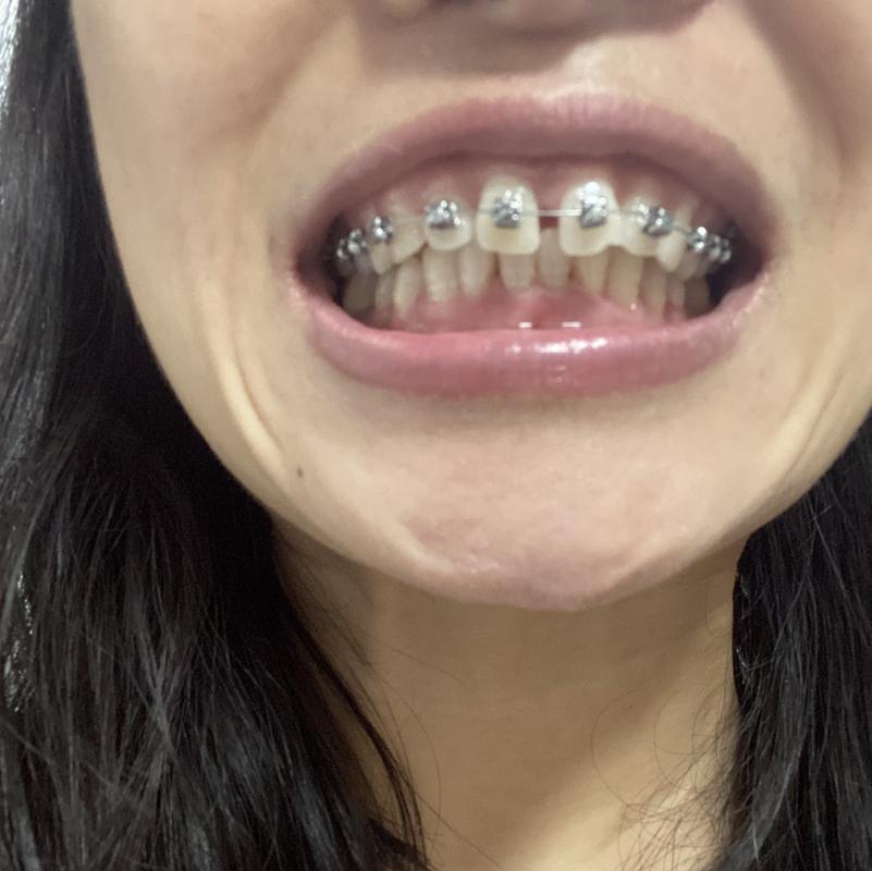 成都40岁还能矫正牙齿吗？真实案例告诉你答案