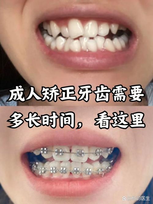 成都41岁做牙齿矫正晚不晚?成人正畸真实经历分享
