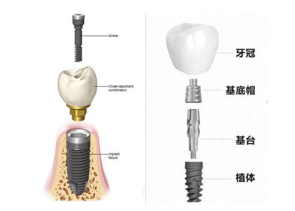 成都种牙全过程要多久？看完心里有数