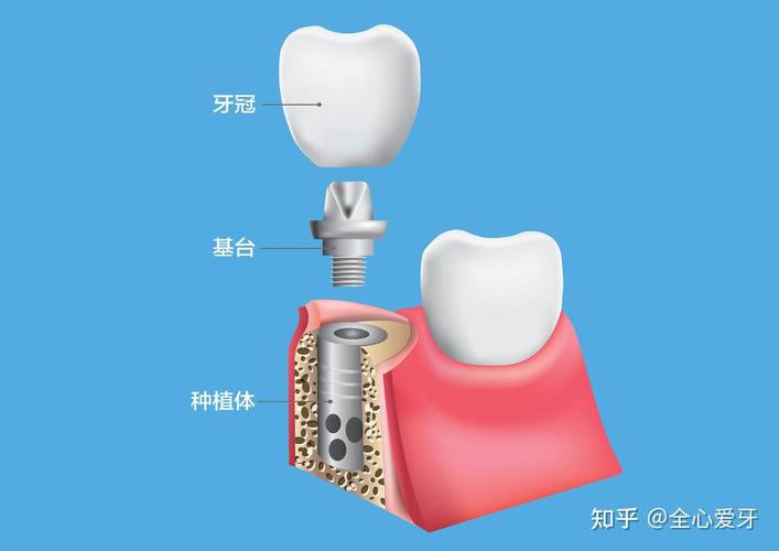 成都青岛种牙集采后 韩系奥齿泰套餐多少钱