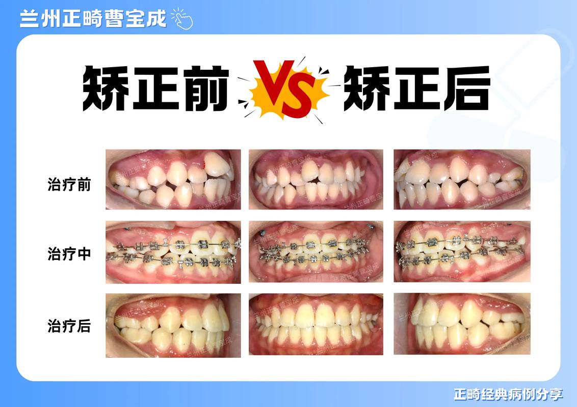 成都北海矫正牙齿不齐要花多少钱？真实价格参考来了