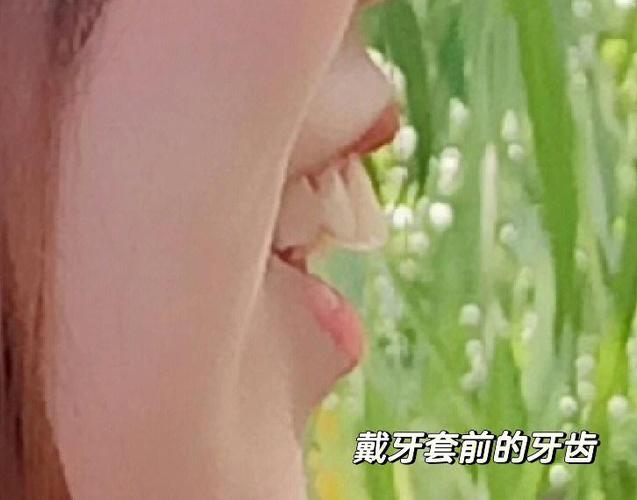 成都深圳骨性龅牙正畸选哪家医院？骨科正畸避坑全攻略