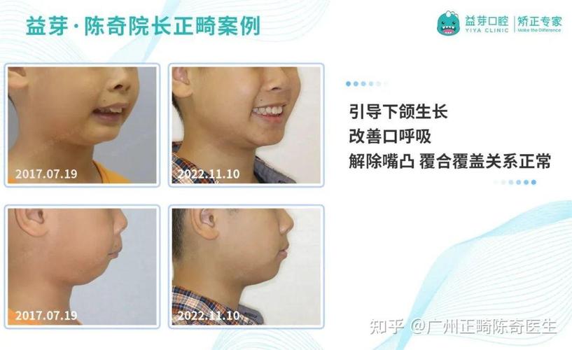 成都东莞儿童牙齿矫正几岁开始最好？家长别等换完牙才后悔
