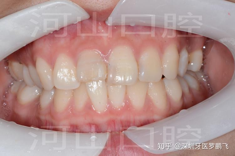 成都20岁牙齿还能不能矫正？成年人正畸真实情况揭秘