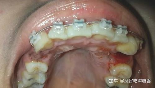 成都宁波青少年牙齿矫正选哪家?费用多少?看完这篇就明白