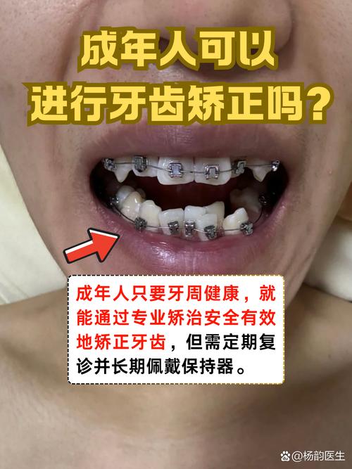 成都30岁矫正牙齿还来得及吗 成年人正畸必看