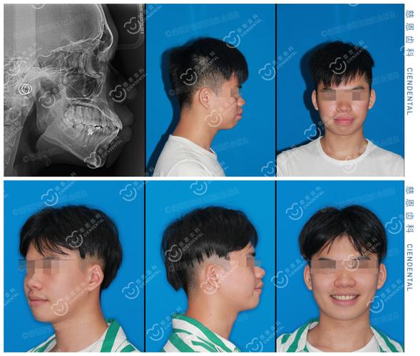 成都深圳罗湖骨性龅牙隐形矫正能行吗？方案详解