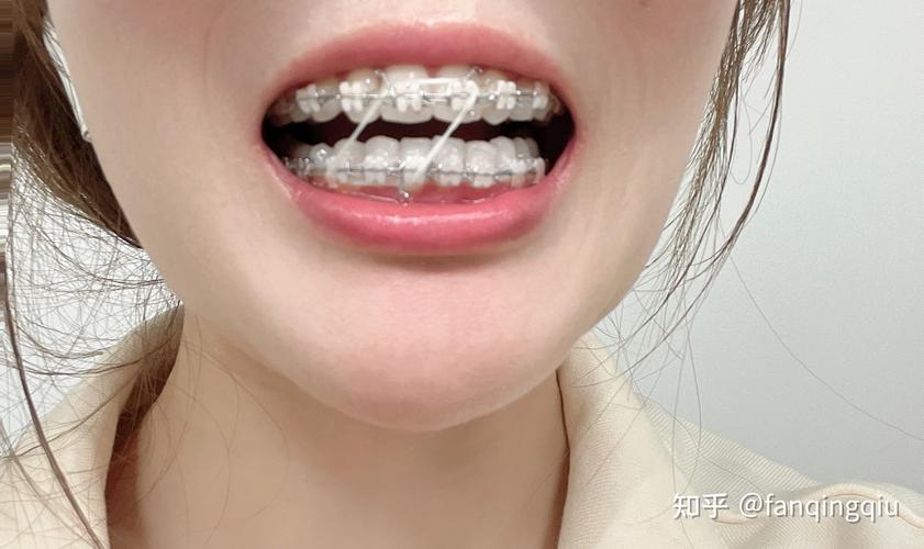 成都27岁做牙齿矫正还来得及吗
