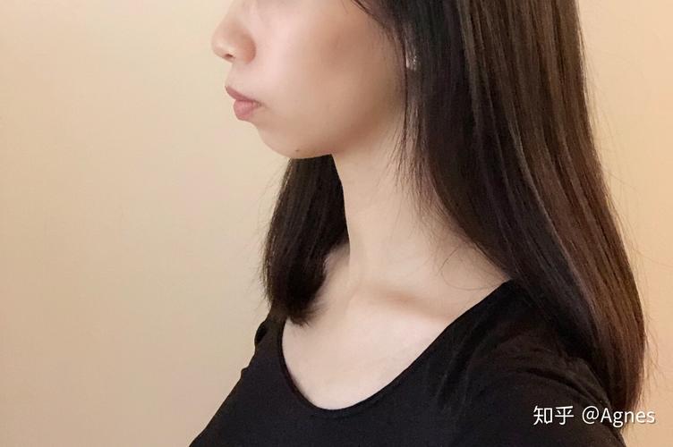 成都深圳龙岗隐适美矫正要多久？看完这篇就清楚了