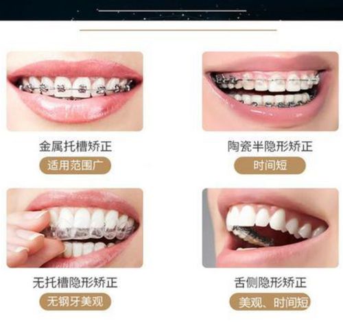 免费咨询上海牙齿矫正_上海矫正牙齿的好处_上海牙齿矫正方案