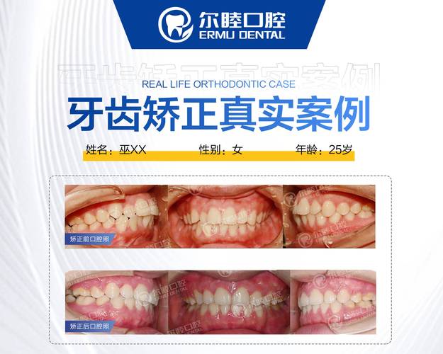 成都深圳宝安金属自锁托槽矫正哪里好？公立和私立医院怎么选