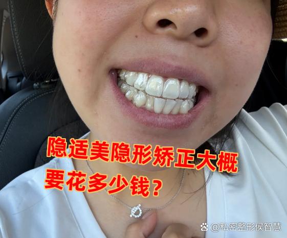 成都深圳龙岗隐适美牙套多少钱？收费明细看这篇