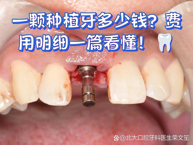 成都深圳种牙贵不贵？揭秘诺贝尔种植牙门诊真实收费明细