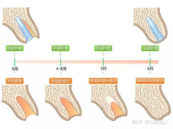 成都掉3颗牙怎样种植？种牙流程全解析+费用避坑指南