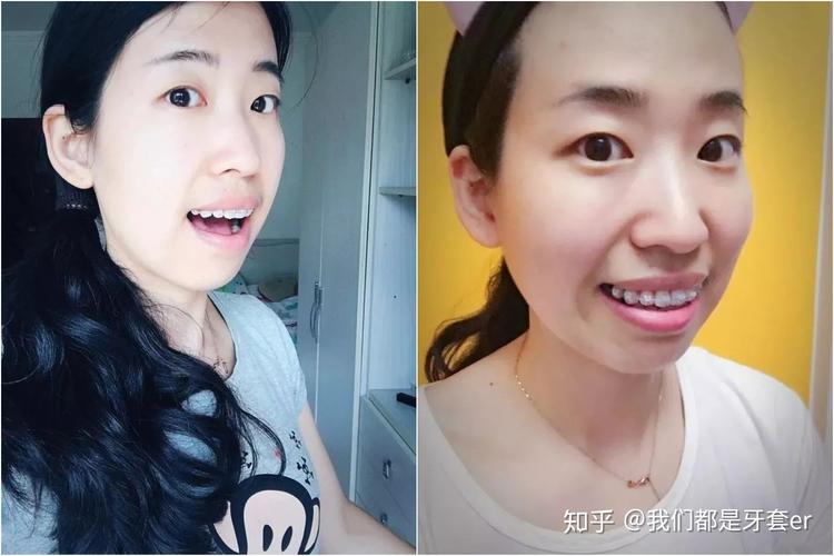 成都30岁做牙齿矫正晚不晚？真实情况告诉你