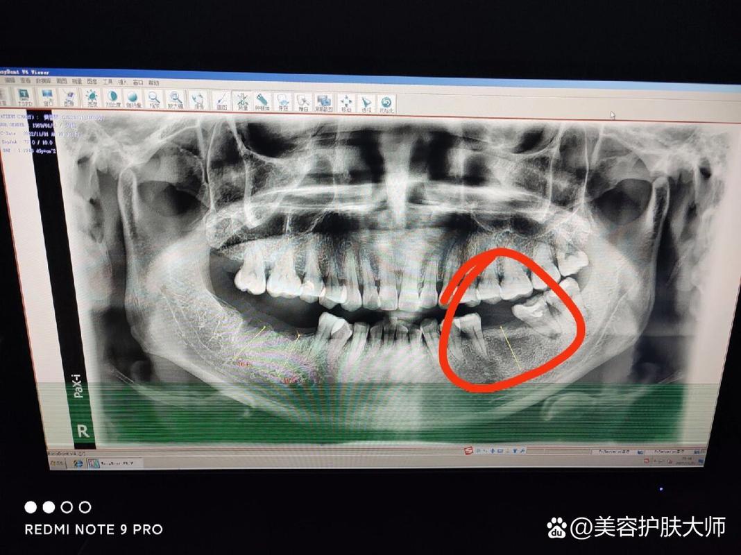 成都深圳皓圣种植牙医院靠谱吗 真实推荐指南
