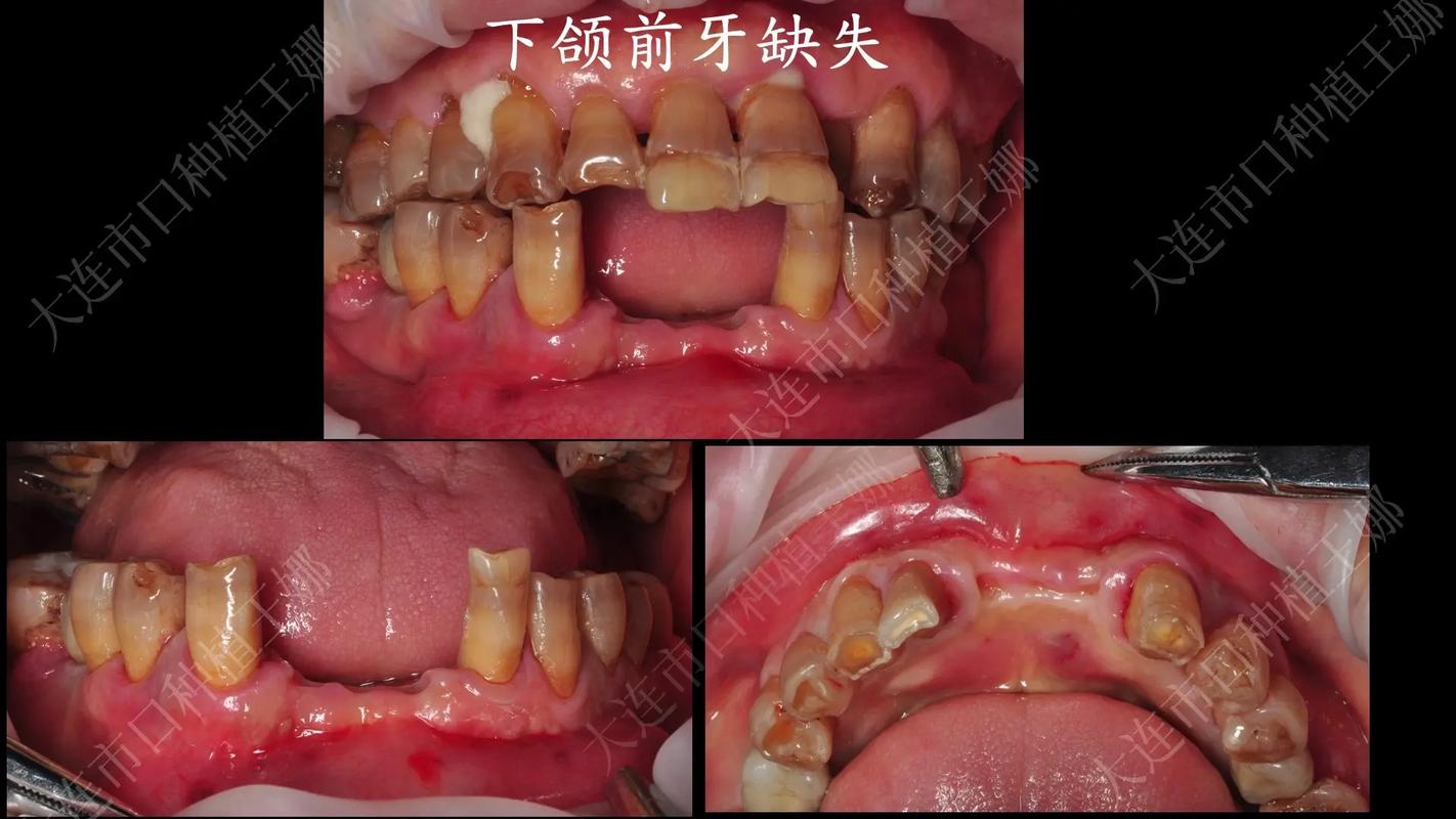 成都拔前牙能整好牙吗？真相与风险全解析