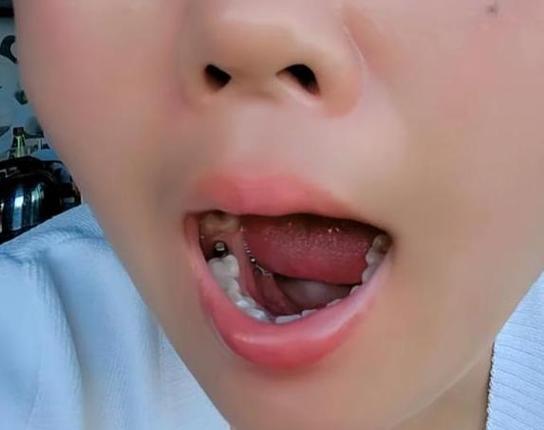 成都55岁种牙好还是镶牙好？一文告诉你答案