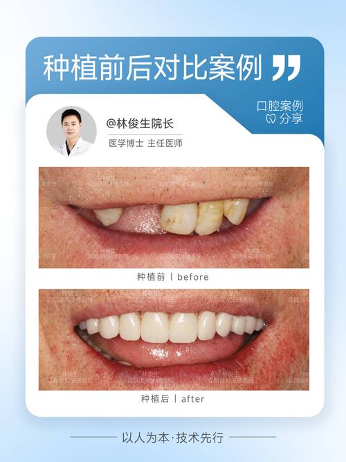 成都罗湖东门种牙多少钱 2026最新价目表