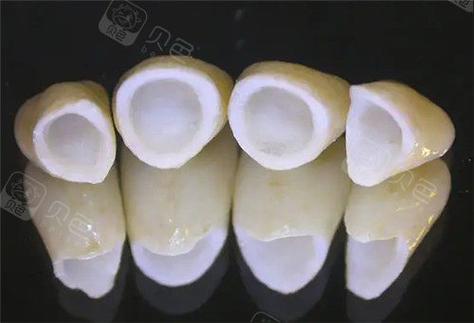 成都深圳做全瓷牙到底要花多少钱？2026年最新报价揭秘
