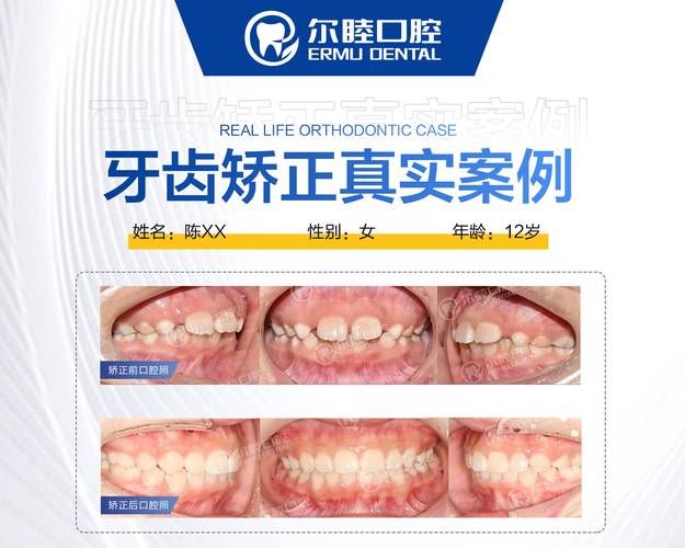 成都深圳西乡牙齿矫正费用到底要多少钱？2026年最新价格参考