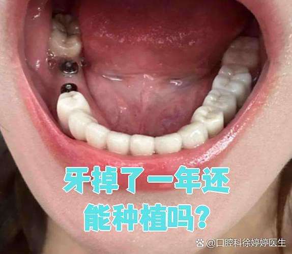 成都牙齿掉了还能种吗？现在种牙靠谱不靠谱