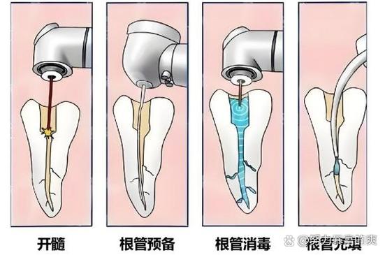 成都种牙要等多久 最佳种牙时间全知道