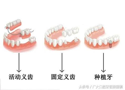 成都儿童乳牙缺失别着急 种植牙修复方案全解