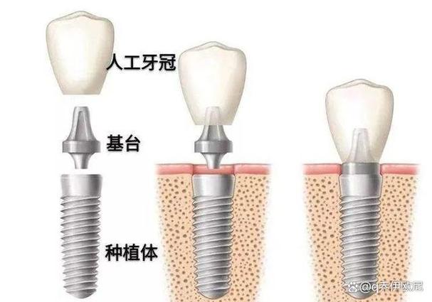成都集采种牙和自费种牙到底差在哪