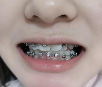 成都30岁做牙齿矫正有什么后遗症？看完这篇不踩坑
