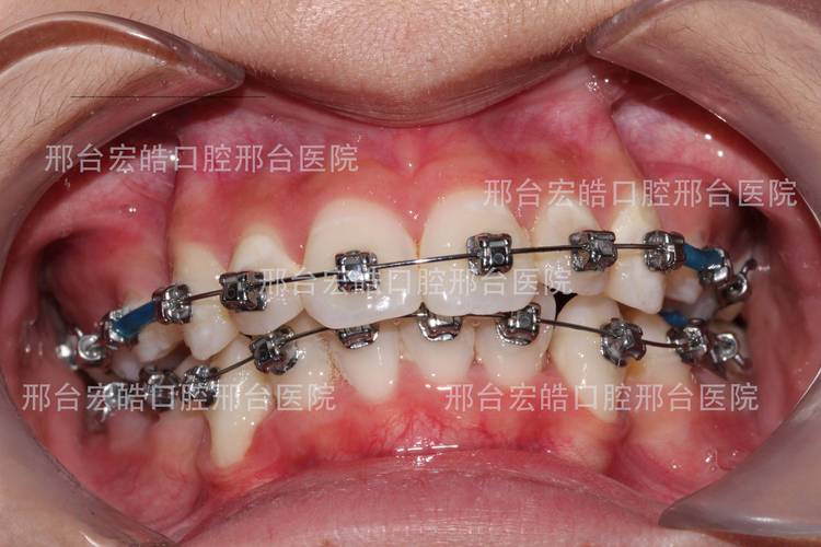 成都不整齐牙齿矫正到底要花多少钱？大概多久能好？